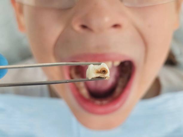 Best Dental Abscess Treatment in North Decatur, GA
